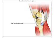 Knee Tendon Bursitis Goosefoot