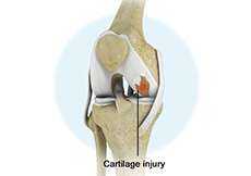 Meniscus Tear Knee Cartilage