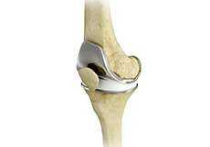 Total Knee Replacement