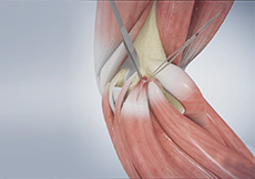 Surgery for Golfer’s Elbow