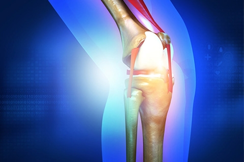 5 Questions to Ask Before Knee Replacement Surgery