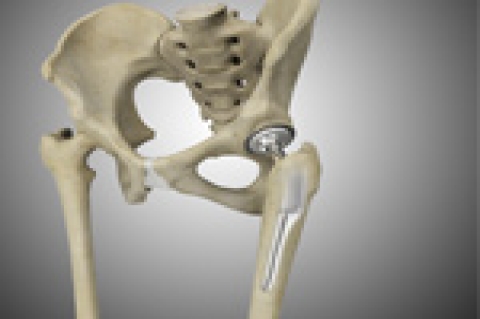 How Total Joint Replacement Can Prevent Chronic Disease