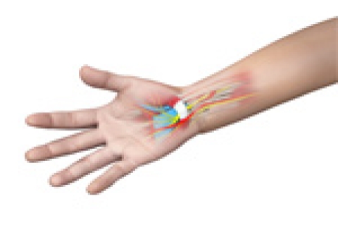 Is Your Hand Pain Caused by Carpal Tunnel Syndrome?