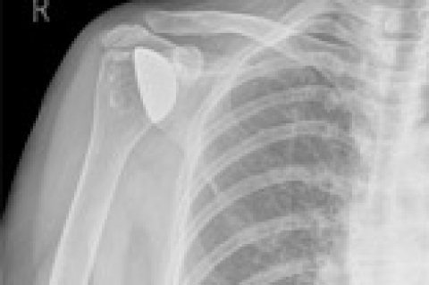 Things to Know before Shoulder Replacement Surgery