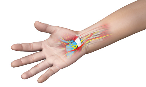 Carpal Tunnel Syndrome Causes Delray Beach, FL