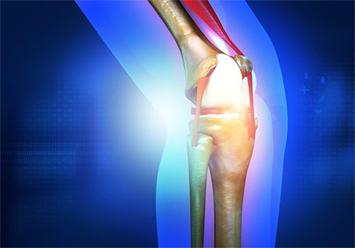 5 Questions to Ask Before Knee Replacement Surgery