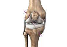 ACL Tear and Reconstruction Knee Ligament Injury