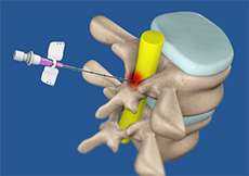 Advanced Pain Management Intervention