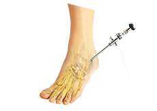 Ankle Arthroscopy