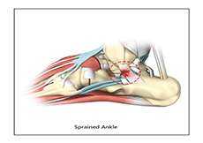 Ankle Sprain and Instability