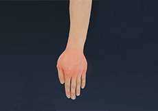 Complex Regional Pain Syndrome (CRPS) - Reflex Sympathetic Dystrophy (RSD)