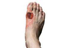 Diabetic Foot