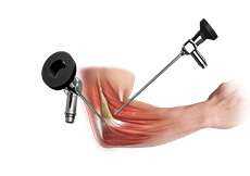 Arthroscopy