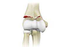 Elbow Fractures