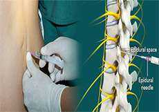 Epidural Cortisone Injections