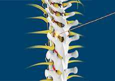 Facet Joint Injections
