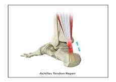 Achilles Tendon Tear and Repair