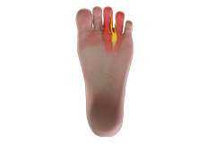 Morton's Neuroma Foot