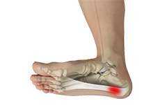 Plantar Fasciitis