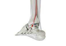 Posterior Tibial Tendon Dysfunction - Acquired Flatfoot