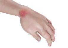 Hand Infections