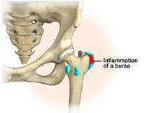 Hip Bursitis