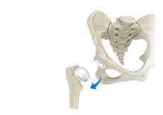 Hip Dislocation