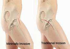 Minimally Invasive Hip Replacement Arthroplasty