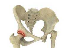 Osteoarthritis of the Hip