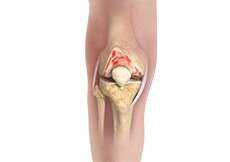 Osteoarthritis of the Knee