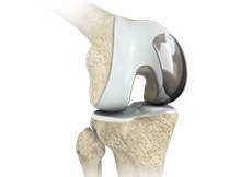 Partial Knee Replacement