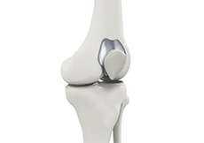 Patellofemoral Syndrome Kneecap Problems