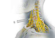 Peripheral Nerve Blocks
