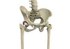 Revision Hip Replacement