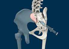 Sacroiliac Injections