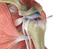 Rotator Cuff Repair