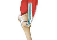 Hamstring Muscle Injuries