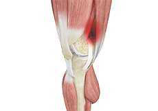 Iliotibial Band Syndrome