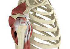 Rotator Cuff Tear and Repair