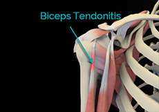 Tendonitis