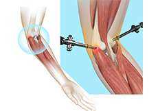 Tennis Elbow Surgery