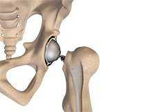 Total Hip Replacement