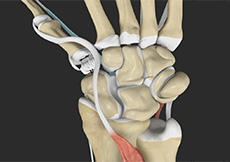 Thumb CMC (Basal Joint) Arthroplasty