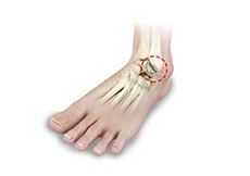 Foot and Ankle Arthritis