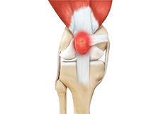 Knee Joint and Bursa Infection