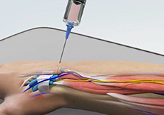 Wide-Awake Hand Surgery (In-Office)